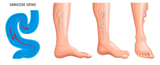 Varicose Veins